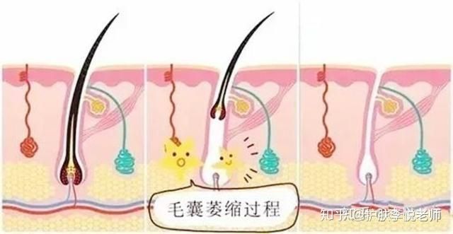 猕猴桃去除体毛,如何永久除去身体体毛