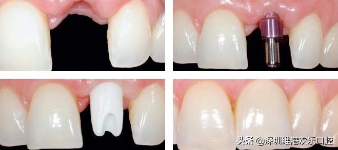 种种植牙对身体有危害吗,种植牙对身体危害吗