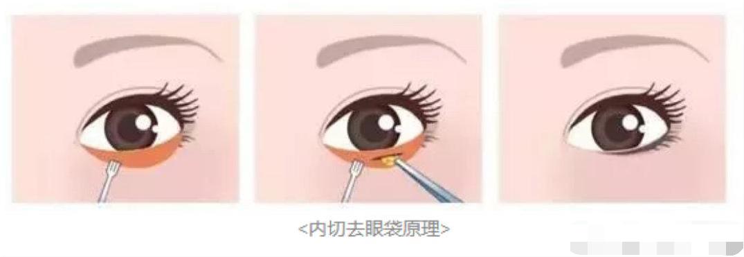双眼皮眼袋术后真实案例,眼袋手术前视频