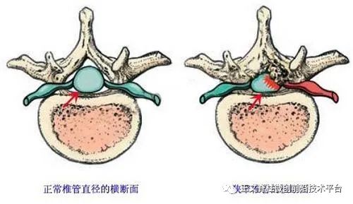 腰椎管狭窄相关知识,一文看懂骶管囊肿