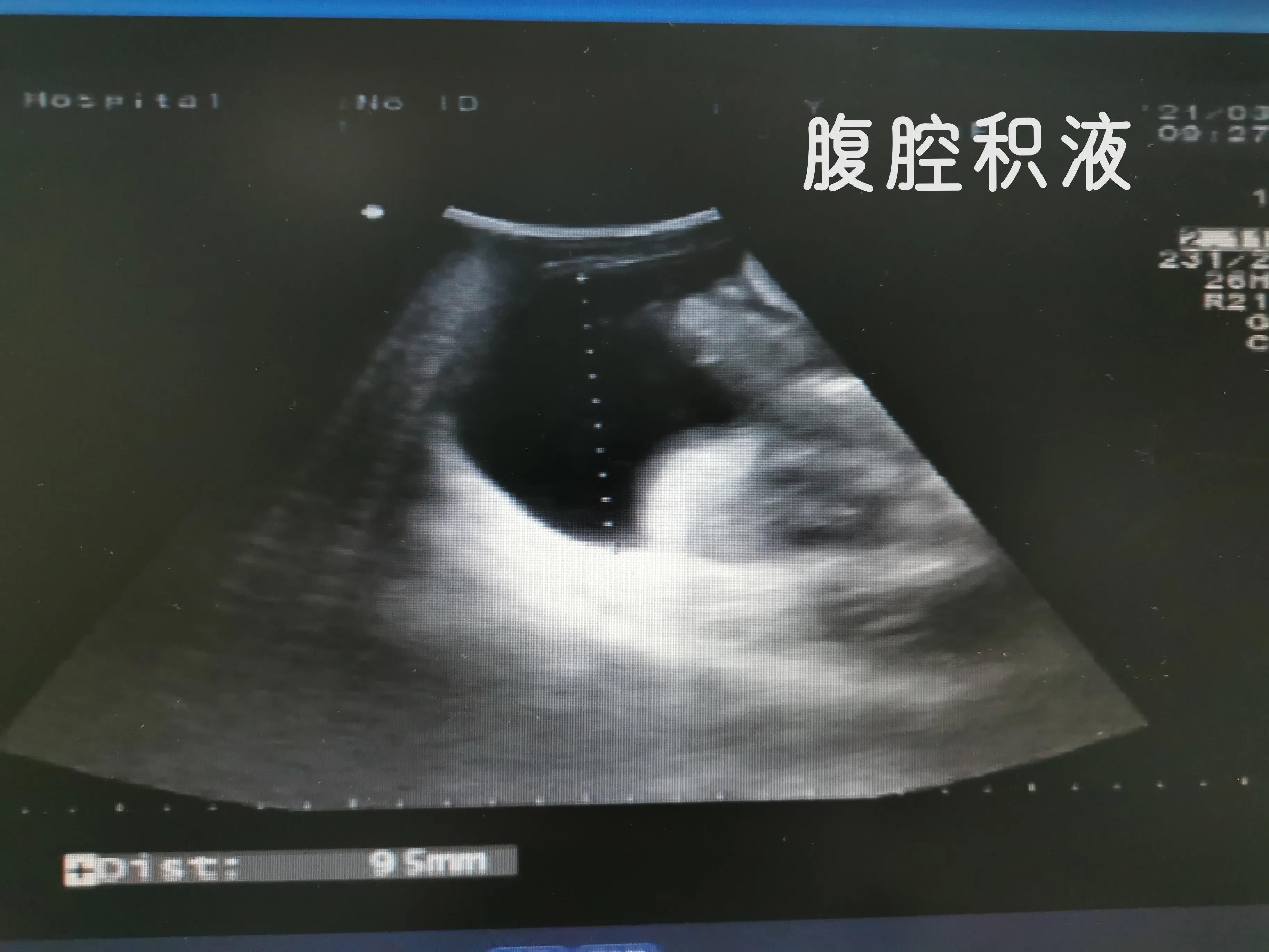 乙肝肝硬化和丙肝肝硬化的区别,乙肝肝硬化肝部占位是肝癌吗