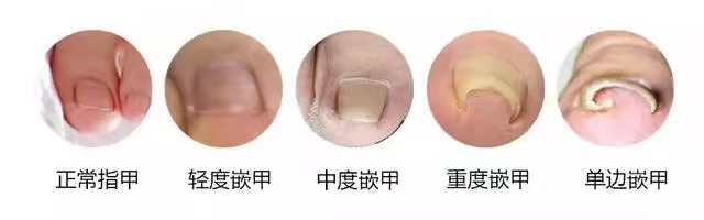 大脚趾甲很厚往肉里长怎么治疗,大脚趾甲受伤后变厚变脆怎么恢复