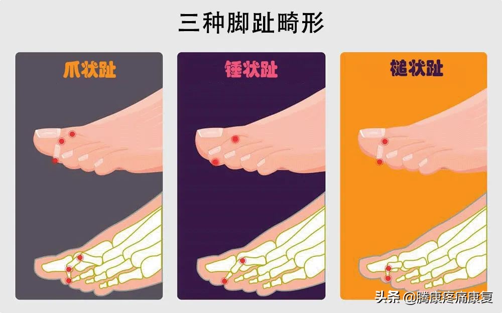 引起足部疼痛的原因,足底筋膜炎疼痛位置图