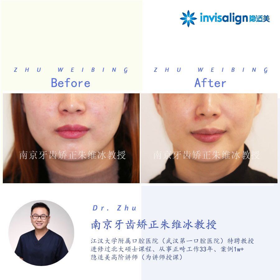 南京口腔医院矫正一颗牙齿多少钱,大医院为啥不建议做牙齿矫正