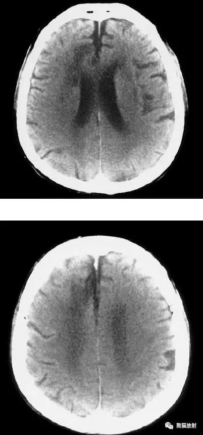各部位脑梗死ct影像讲解,脑梗死ct影像最简单的是什么表现