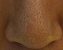 泰国去黑头的正确方法,大米去黑头的正确方法