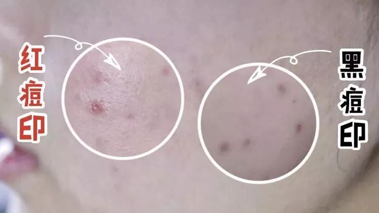 如何处理痘痘留下来的黑印,痘痘留下的痘痕怎么快速消除