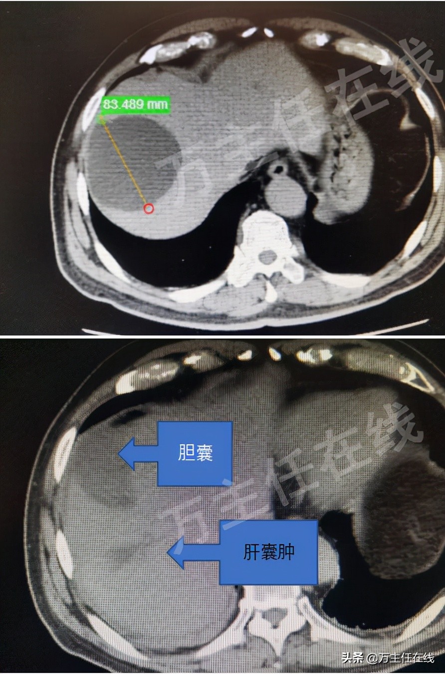 消化内科肝脏手术,肝部囊肿切除手术