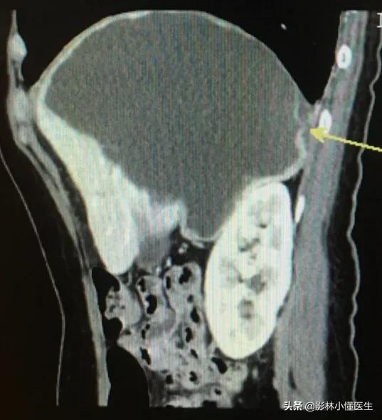 肝囊肿介入治疗后能维持多长时间,肝囊肿1.4*1.1需要治疗吗