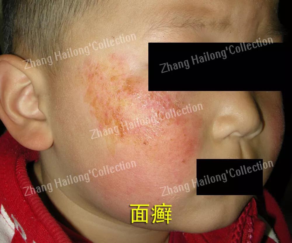 孩子脸上长癣怎么办,孩子脸上长癣是怎么回事啊