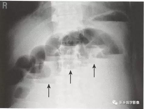 辨识肠梗阻,肠梗阻死亡前兆