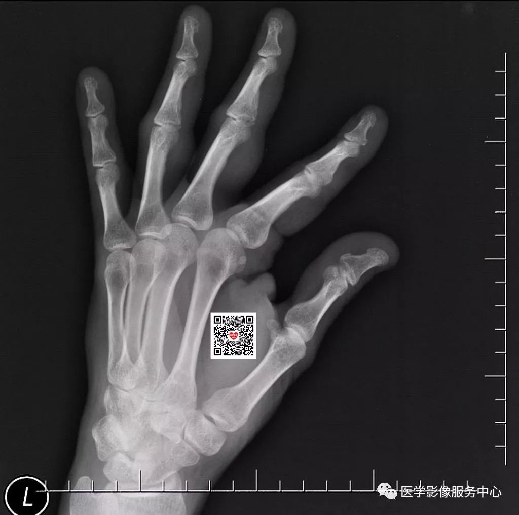 常见的骨折漏诊部位及如何避免,不经意骨折