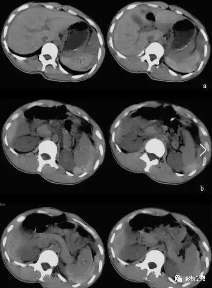 16种常见急性腹痛的诊断与鉴别