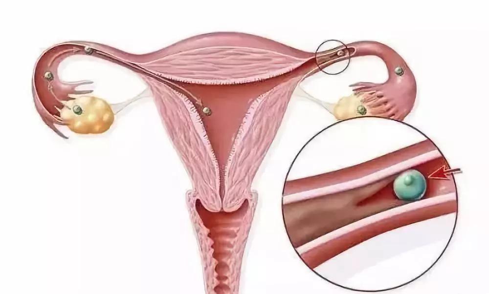 输卵管通但是老怀不上怎么回事,输卵管通而不顺畅怎么治疗