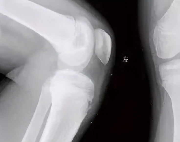 青少年无缘无故的腿疼,青少年腿疼怎么办