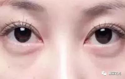 眼袋下垂很显老？教你一个小方法，纯天然收眼袋，眼袋自然变平