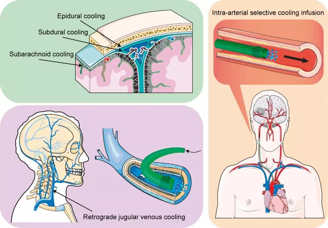 拥有7000年历史的“低温疗法”如何保护神经功能？