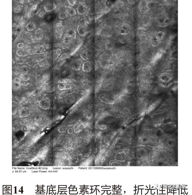 皮肤共聚焦显微镜能查什么,皮肤镜和共聚焦显微镜