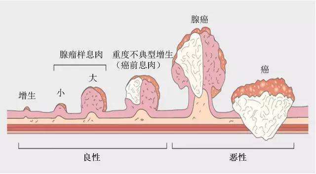 发现肠息肉就必须马上切除吗,得了肠息肉就一定要切除吗