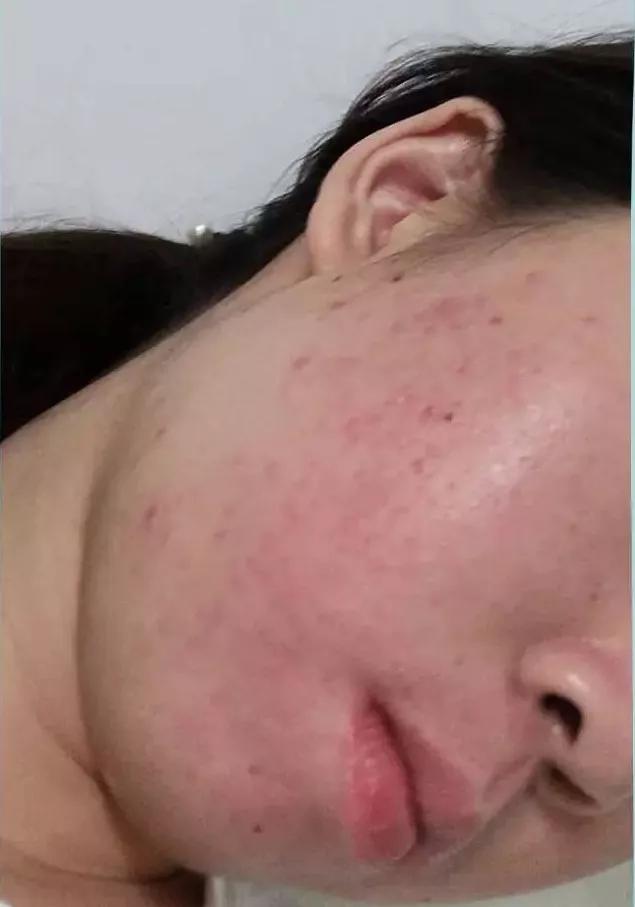 异维a酸软胶囊治疗痘痘多久见效,异维a酸抑制雄性激素治疗痘痘吗