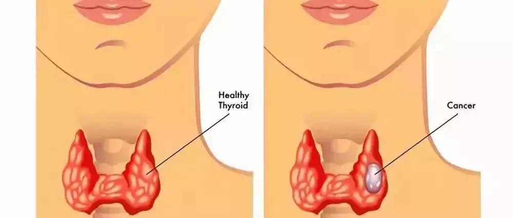 结节囊肿息肉肌瘤有什么区别,囊肿息肉结节能自己消除吗