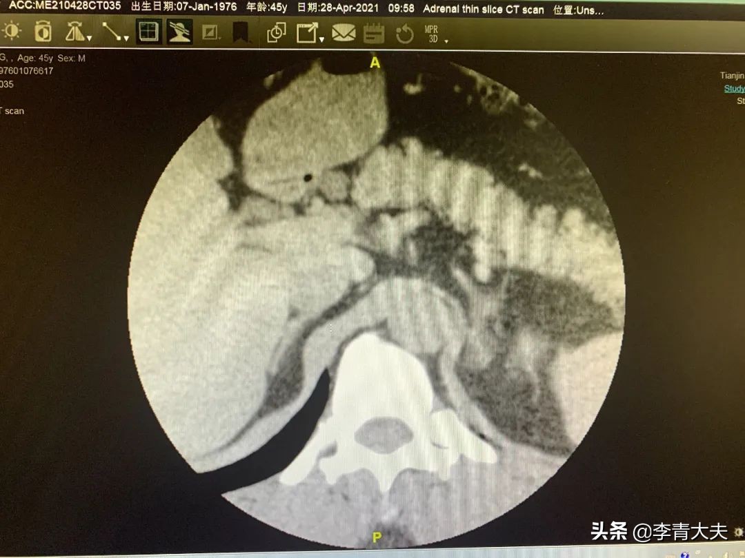 难治性高血压用什么药好,原发性高血压如今最好的治疗方式