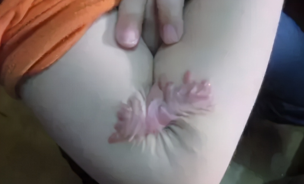 烧烫伤疤痕去除最好办法,烧烫伤疤痕怎么修复