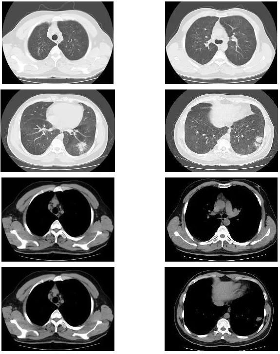 青年男性肺炎过后一直咳嗽怎么办,潜伏结核感染咳嗽咳痰