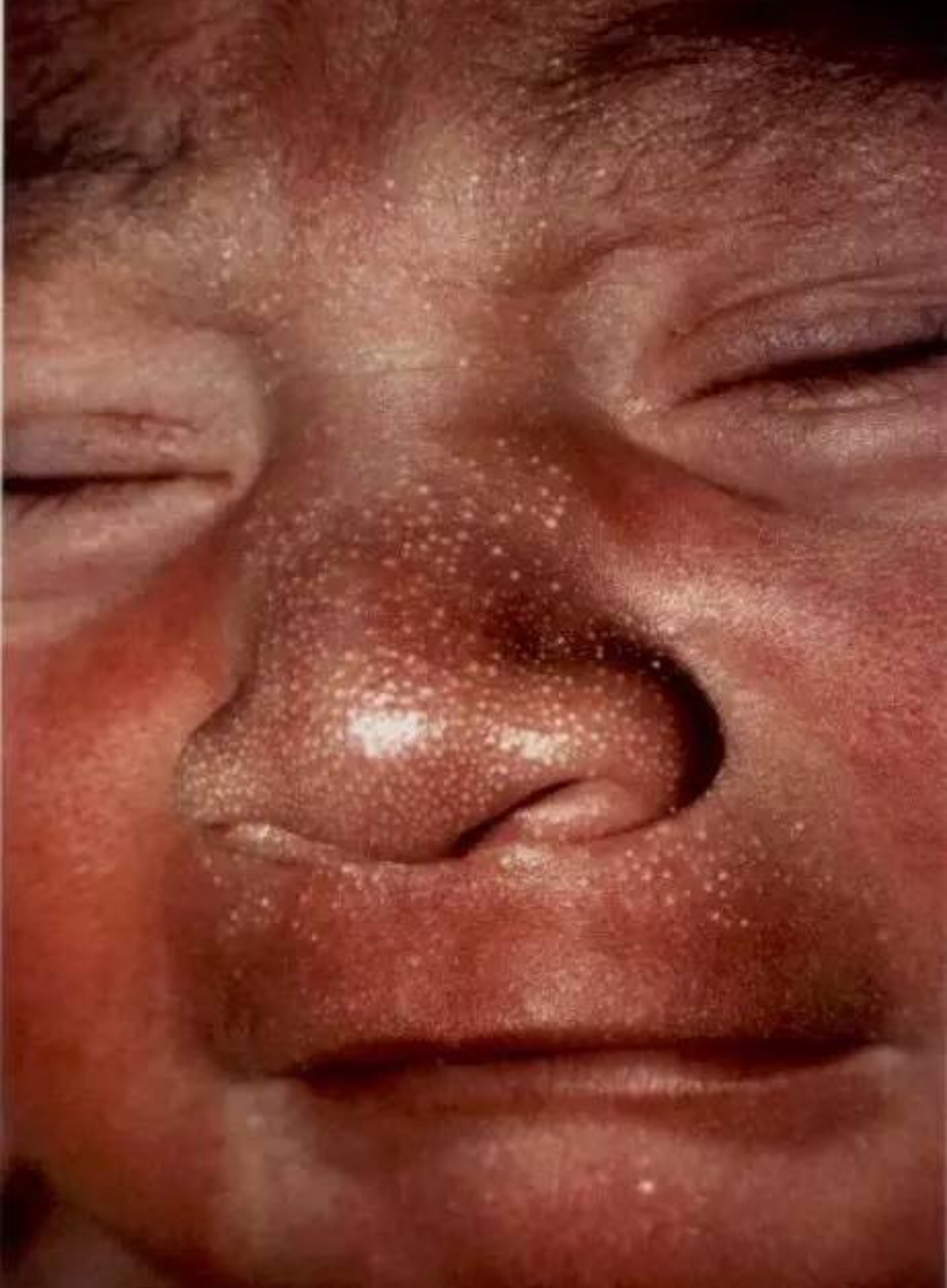 宝宝脂溢性湿疹可以涂什么药膏,宝宝湿疹脂溢性皮炎