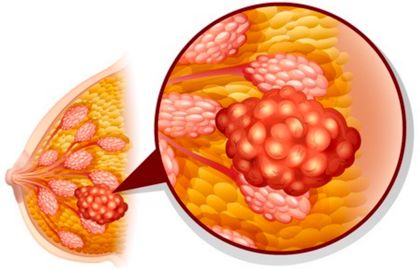 瘫痪老人长期便秘的危害,长期喝酒便秘有什么危害