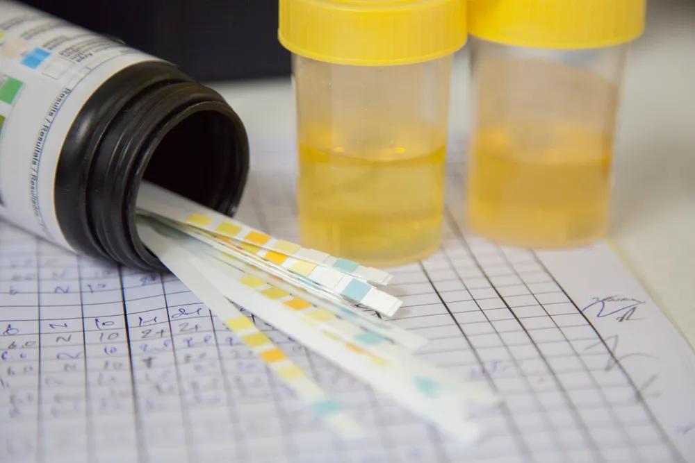 出现蛋白尿要注意哪些事情,尿蛋白9+