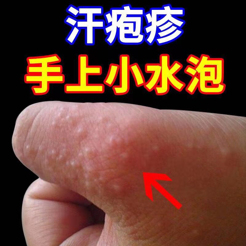 脚底板和脚趾之间长了个水泡很痒,手指缝脚趾缝有小疙瘩痒