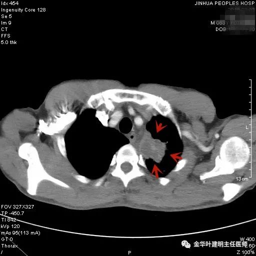 叶建明谈实性结节,叶建明肺实性良性结节会变癌症吗