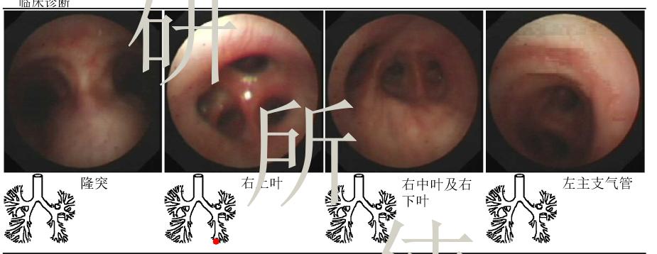 肺部陈旧病灶会变大么,肺部病灶1.2厘米严重吗