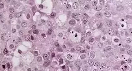 肿瘤病理报告怎么看,肿瘤怎样看病理报告