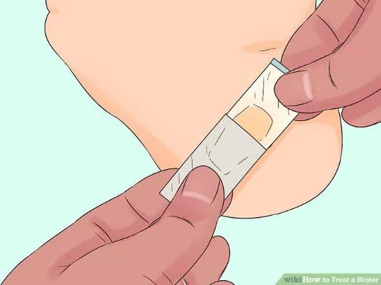 如何预防与处理比跑步膝痛还烦人的水泡？