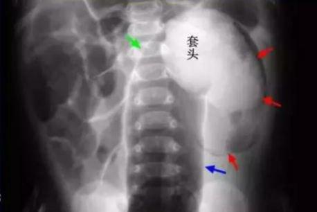 小孩肚子不消化哭闹,小孩肚子痛半夜哭闹如何解决