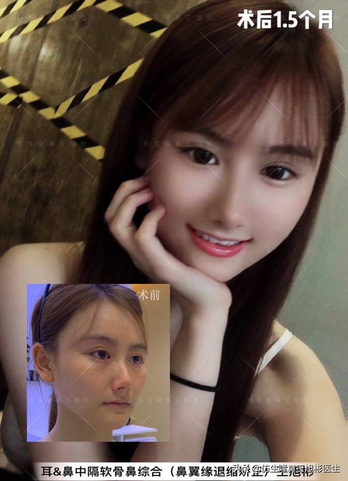 王旭彬：朝天鼻、露鼻孔，模特菲菲短鼻矫正手术后1.5个月