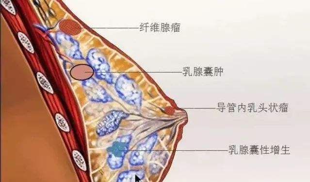 挑战乳腺结节——该选择穿刺活检还是切除活检？（上）