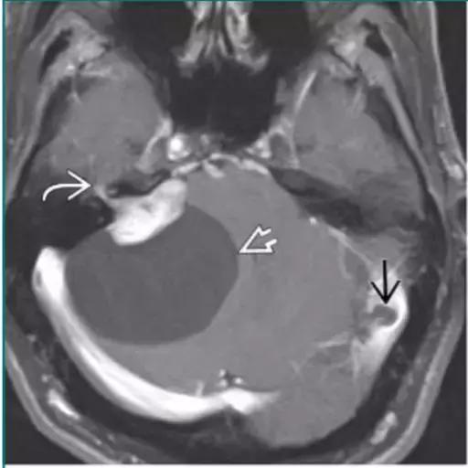 各种囊肿的症状,颅内囊肿18-19mm严重吗
