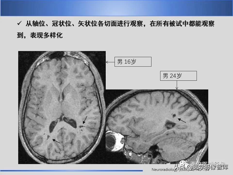 vr间隙概念,vr间隙需要做什么检查