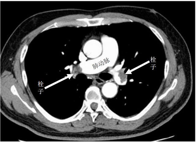已经出现经济舱综合征怎么办,如何预防经济舱综合症