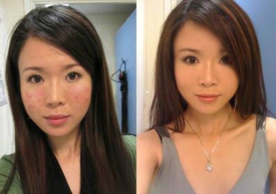 100人里就有20人中招，清洁不到位导致脸上冒虫，毛孔需要早清洁