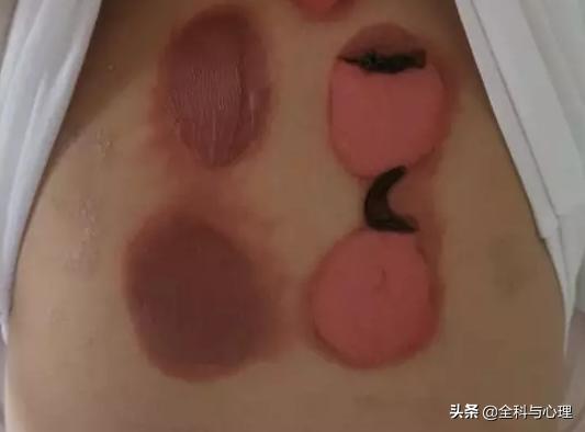 水泡破了可以用敷贴吗,敷贴过敏起水泡怎么处理