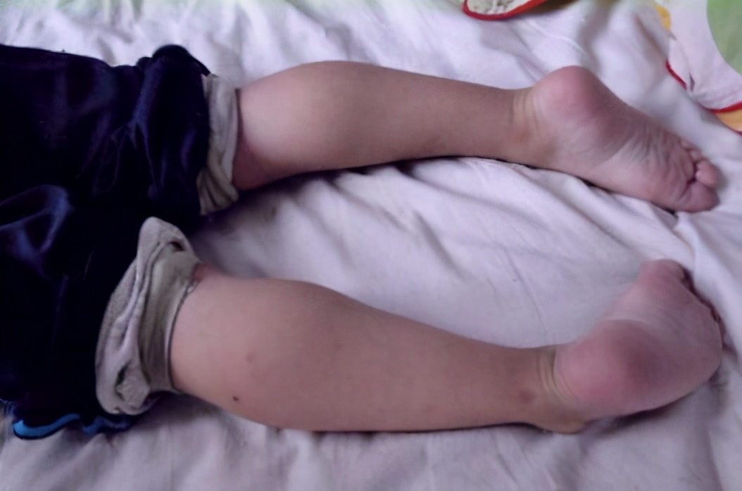 进行性肌营养不良有几种类型,进行性肌营养不良有哪些表现