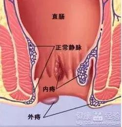 面对痔疮，准妈妈该怎么办？