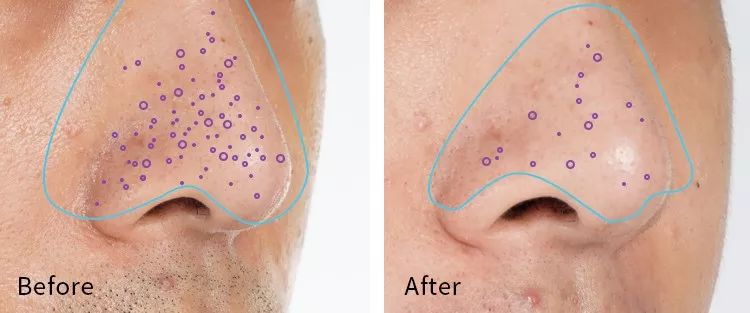 长黑头VS不长黑头差距这么大?精致女孩如何绕过黑头这道坎?