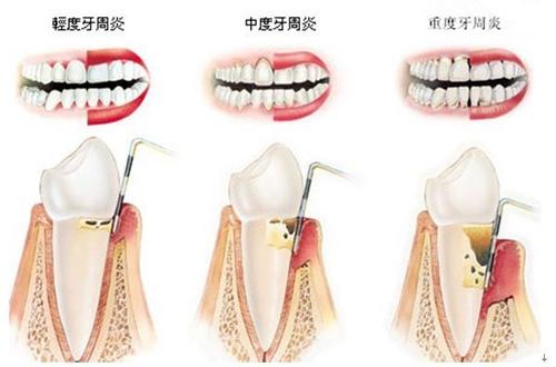 牙龈萎缩造成塞牙最好的解决办法,牙龈萎缩前牙黑三角严重如何修复