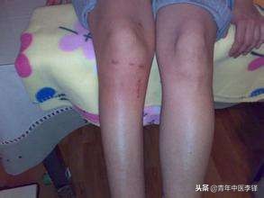 痿证独取阳明的依据是什么,如何理解治疗痿独取阳明的原则