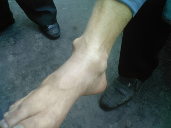 类风湿结节是类风湿关节炎的关节外表现，可运用糖皮质激素治疗